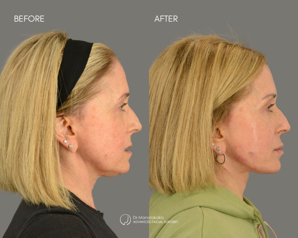 Before and after maxillofacial surgery results showing improved facial profile, jaw alignment, and facial balance