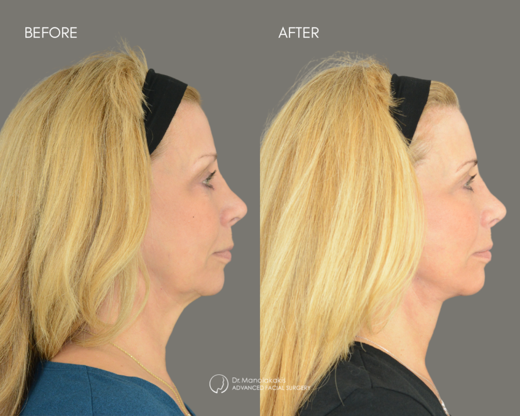 Before and after maxillofacial surgery results showing improved facial profile, chin projection, and overall facial balance