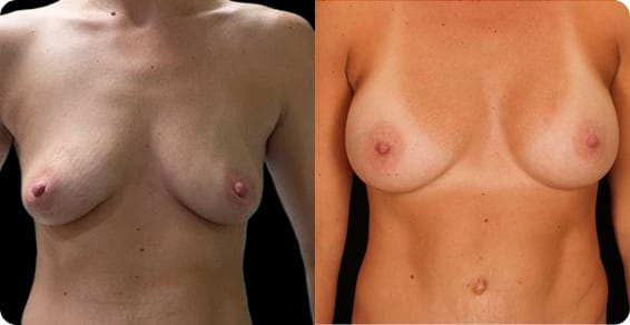 Breast Implants 1 St. Louis Institute