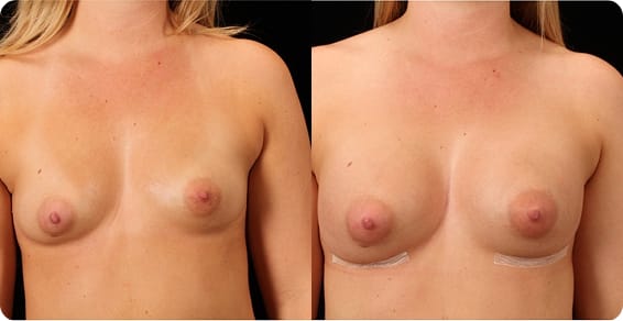 Breast Implants 3 St. Louis Institute