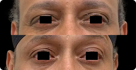 Bleph BA03 2