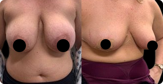 Breast Reduction BA01 1