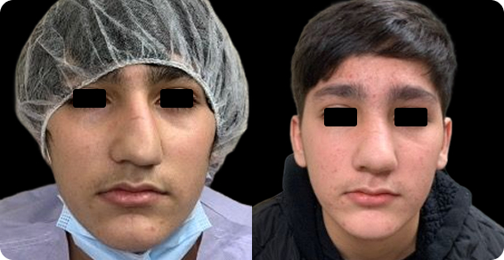 After image