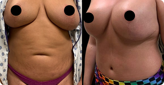 Tummy Tuck BA01 1